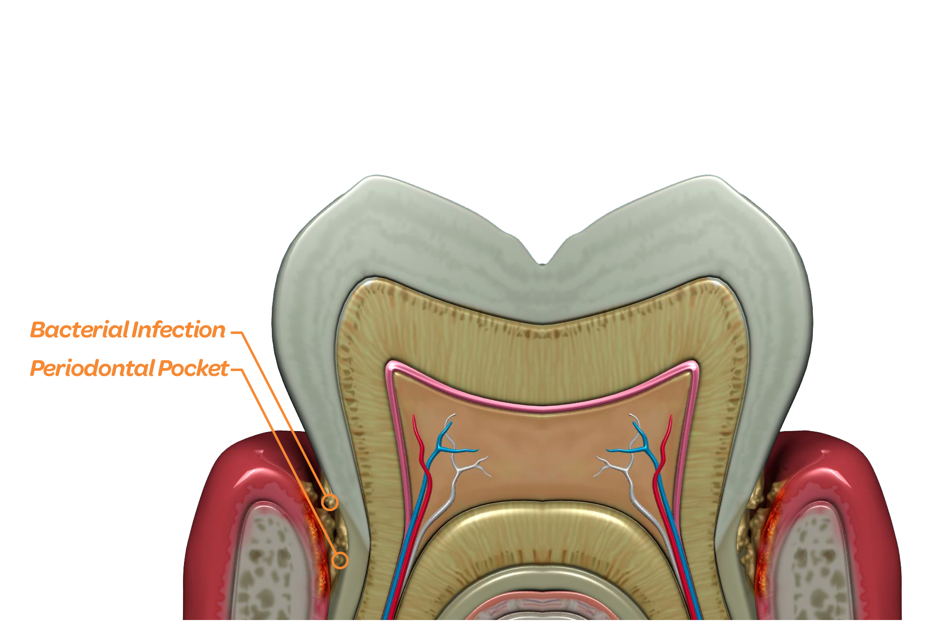 Bacteria thrive deep below the gum line in the periodontal pocket.