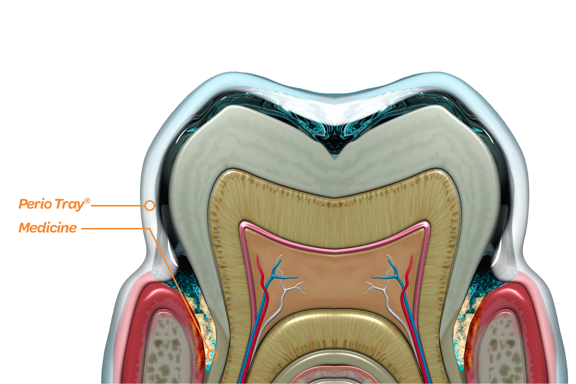 The Perio Tray® delivers medicine into the periodontal pockets and holds it there.
